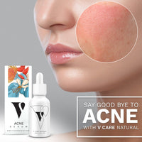 VCARE Natural Acne Serum - VCARE NATURAL